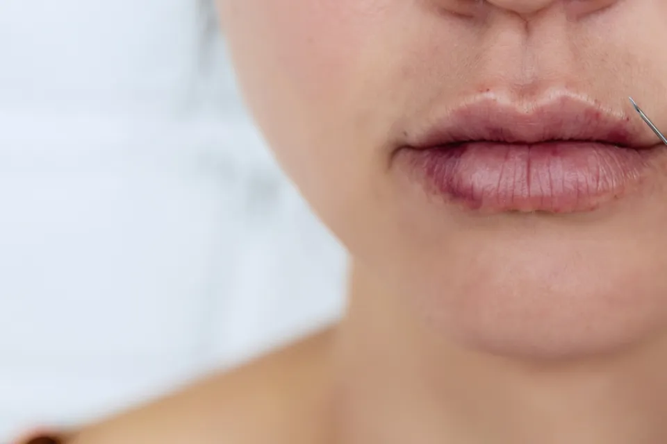How Long Does Bruising Last After Lip Filler? Answered - After SYBIL