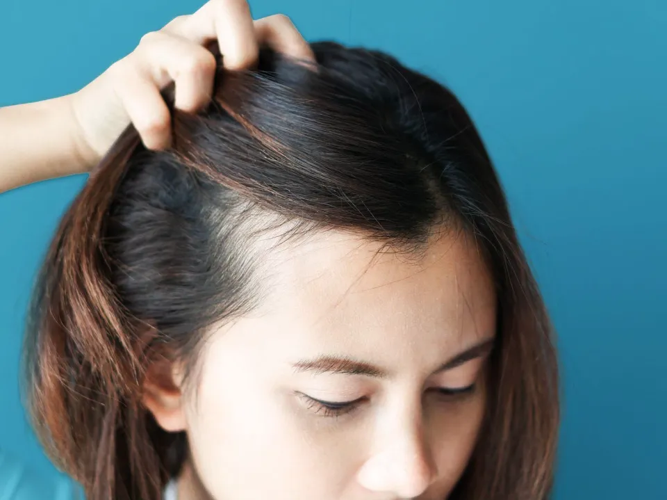 Can Dry Scalp Cause Hair Loss Causes And Treatments After Sybil 