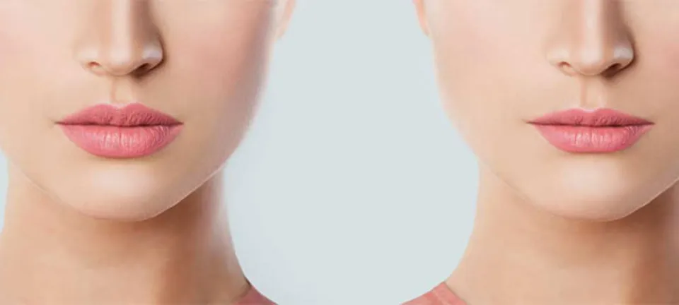 How to Remove Lip Filler